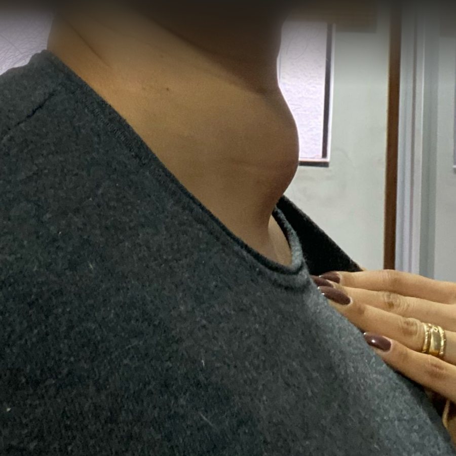 Antes da ablação: pescoço de perfil com abaulamento visível causado por nódulo de tireoide