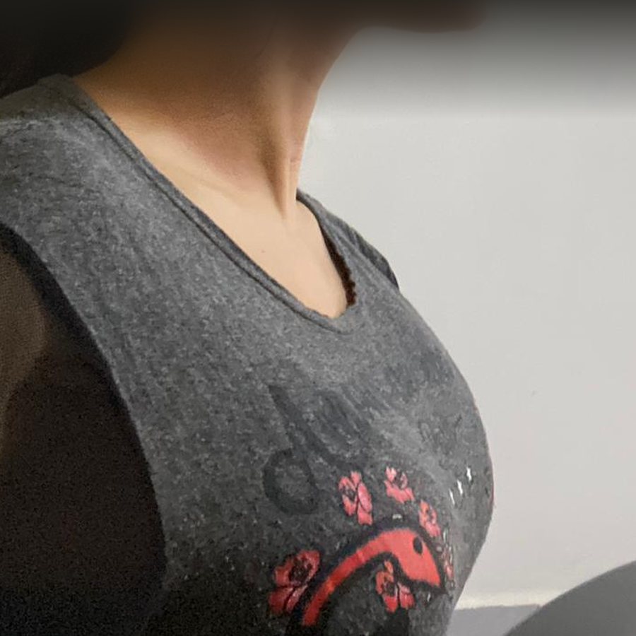 Depois da ablação de tireoide: pescoço de perfil com contorno regular e sem cicatriz
